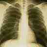 Radiographie du thorax